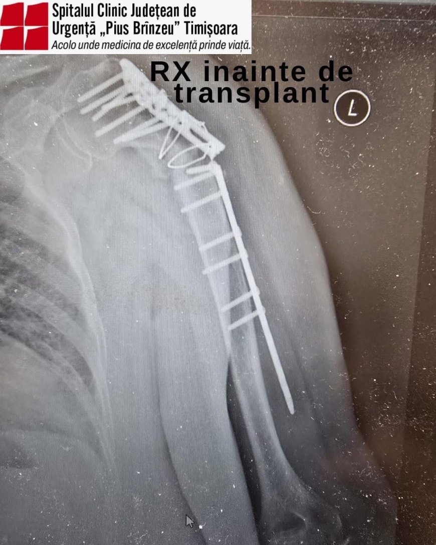 Transplantul de țesut osos, reluat la Spitalul Județean „Pius Brînzeu” Timișoara