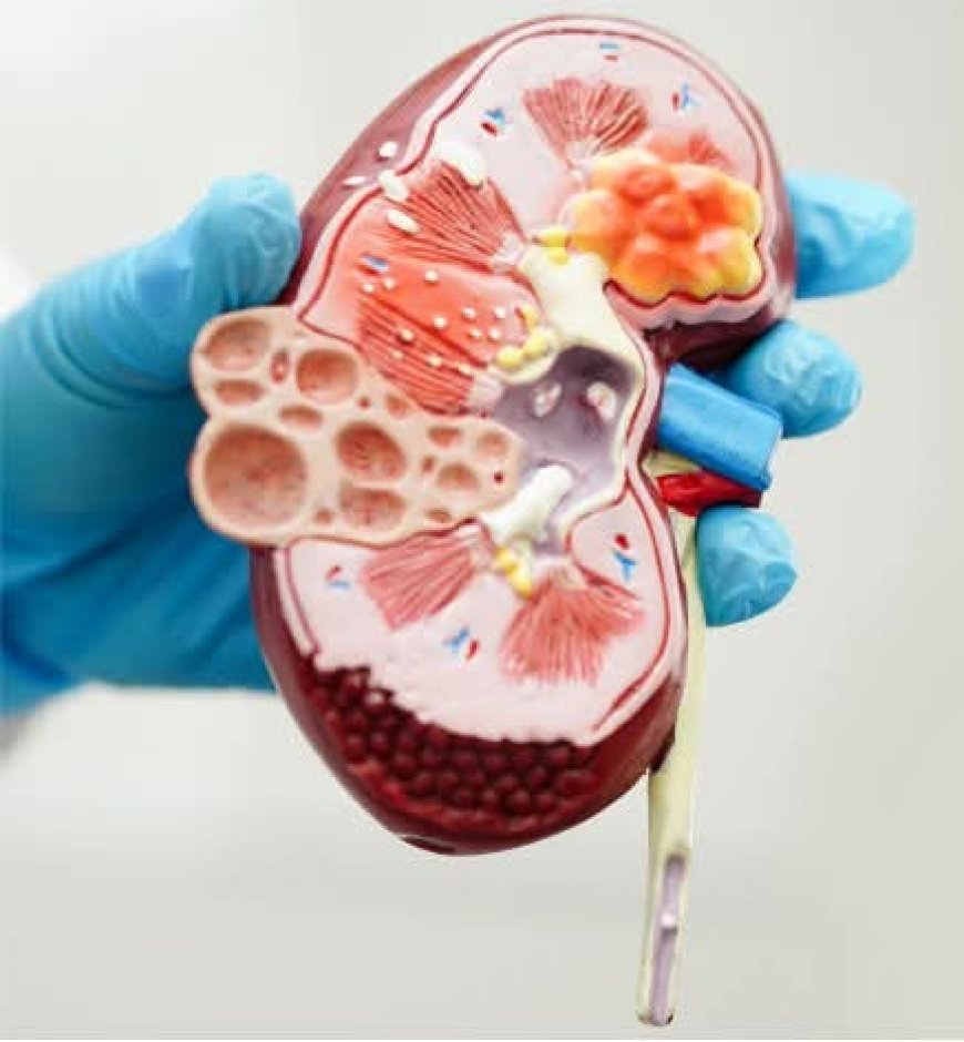 Cancerul renal, afecțiunea oncologică depistată în cazuri avansate